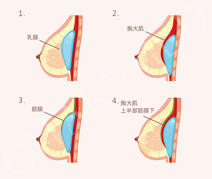 內視鏡隆乳手術