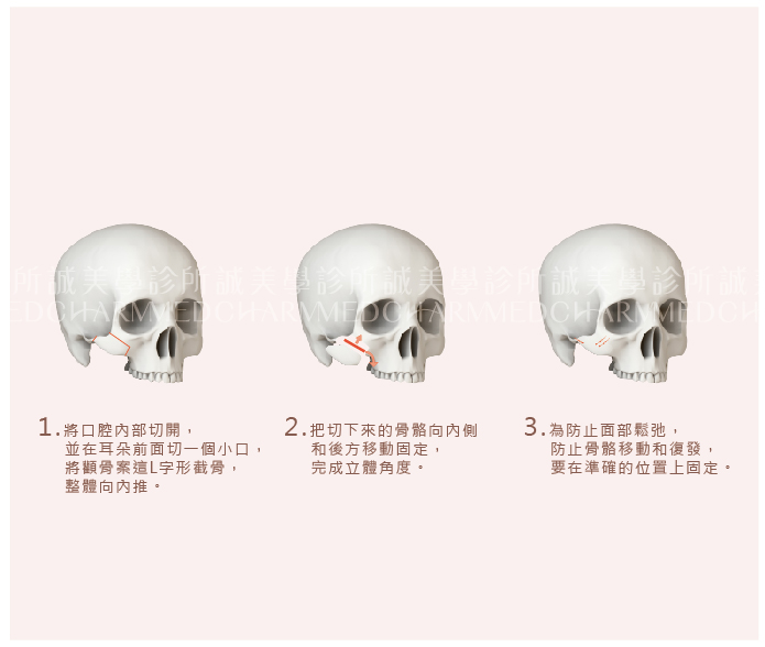 顴骨L形削骨手術