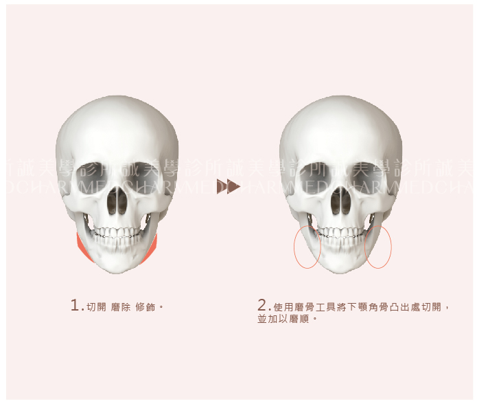 下頷骨削骨手術