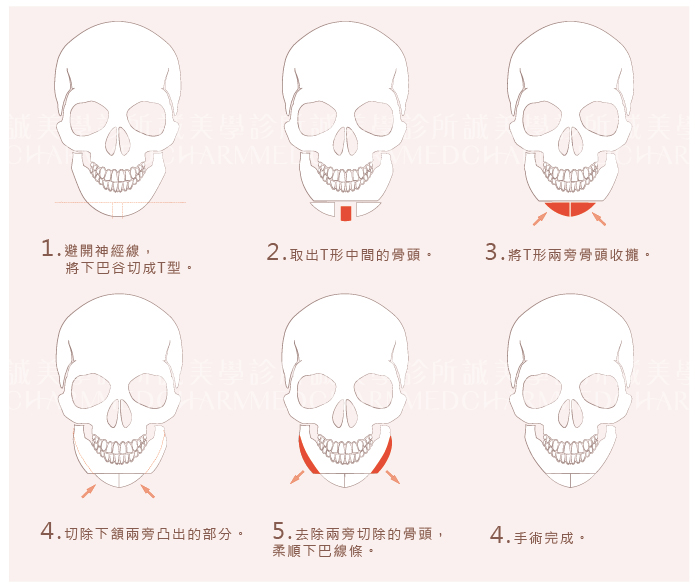 T字下巴截骨手術