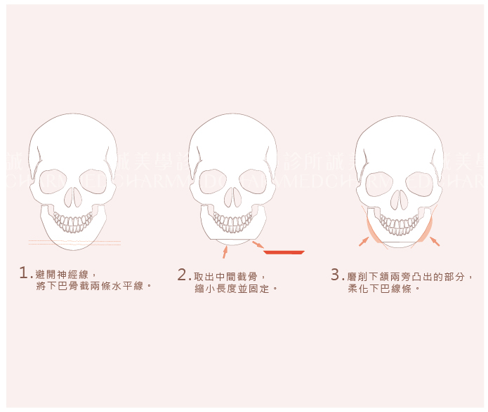 水平下巴截骨手術