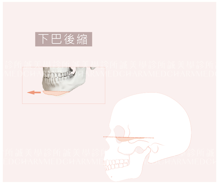 下巴後縮手術