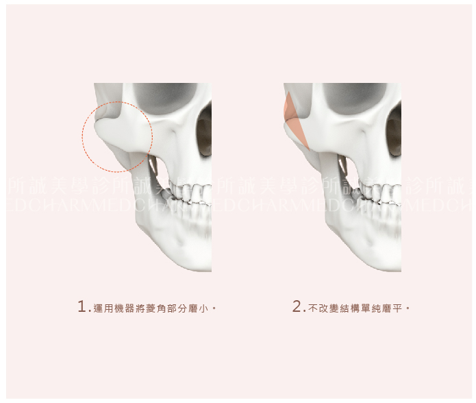 顴骨磨骨手術