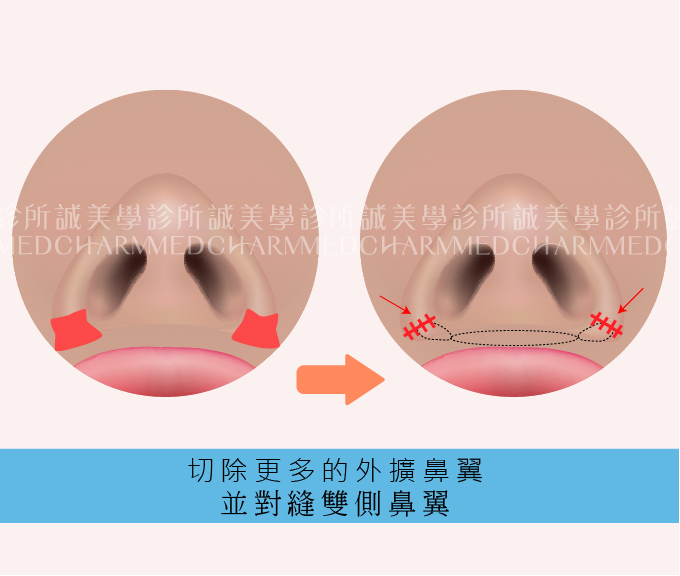 鼻翼縮小外切