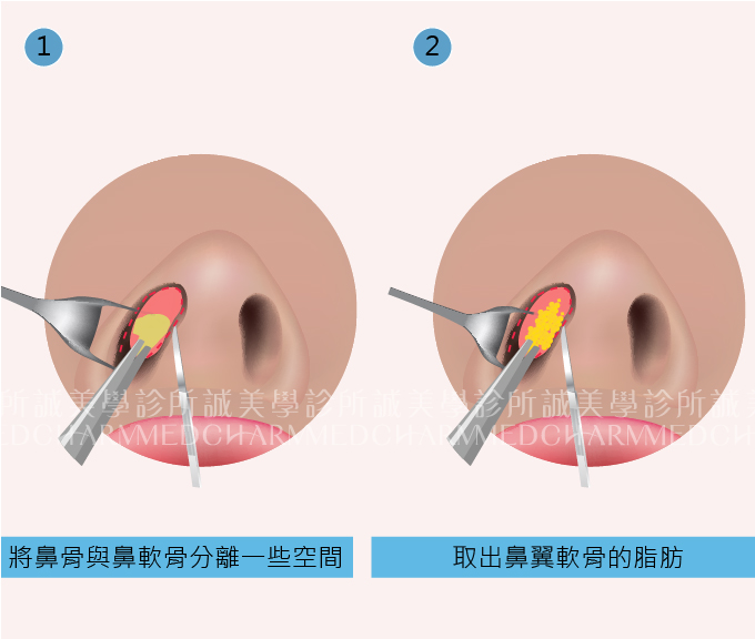 鼻頭整形