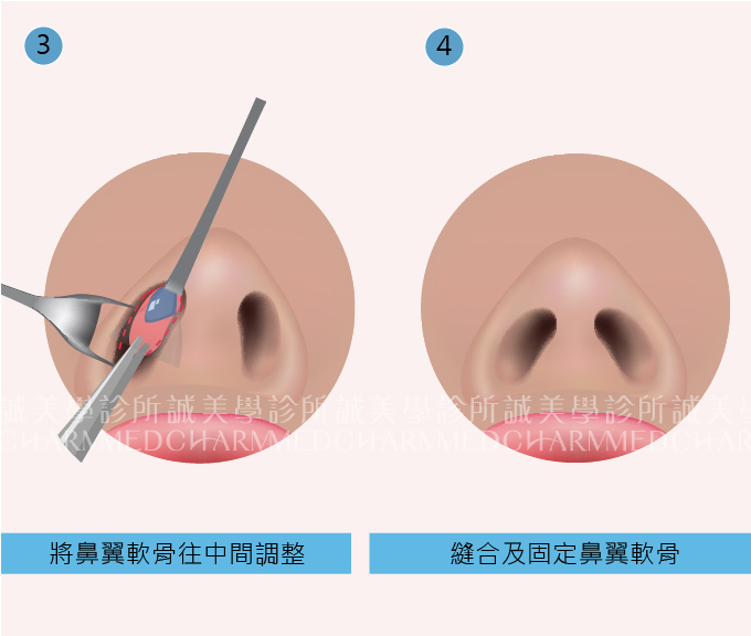 鼻頭整形步驟二