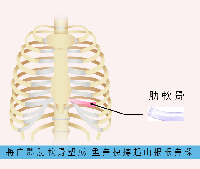 全自體肋軟骨隆鼻