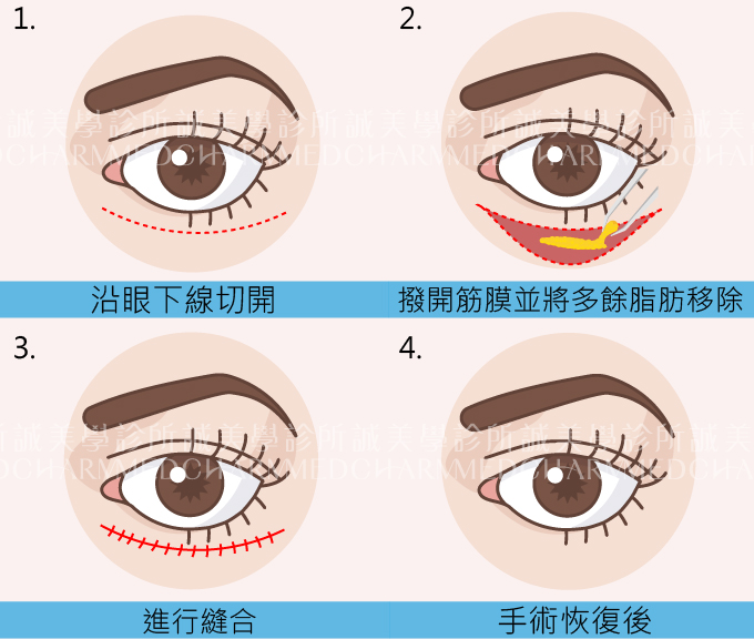 眼袋外開