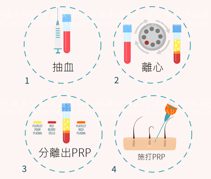 育髮PRP注射