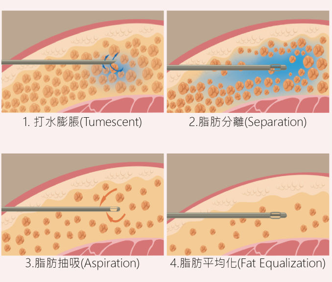 Vaser威塑超音波抽脂手術原理