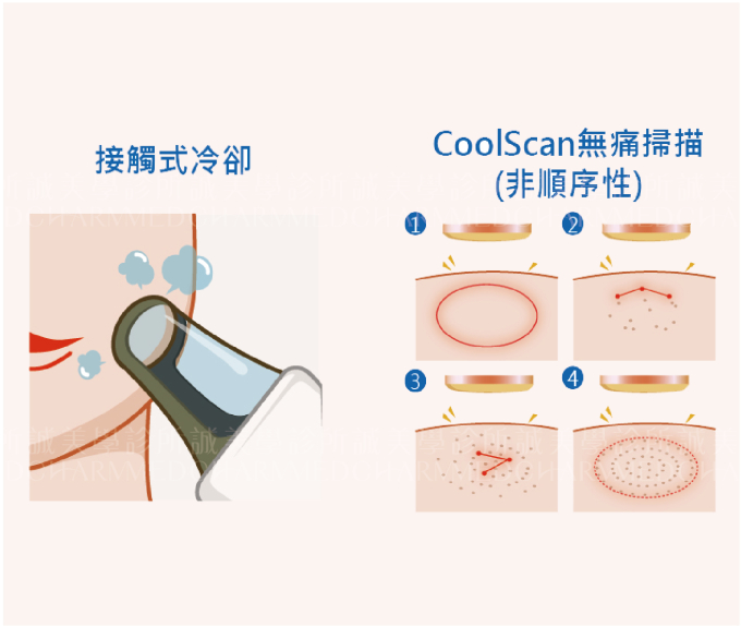 雙眼皮的類型