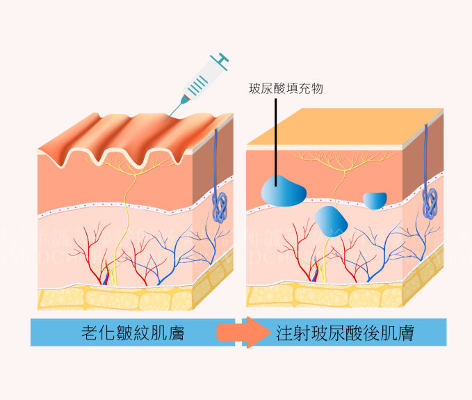 喬亞登玻尿酸