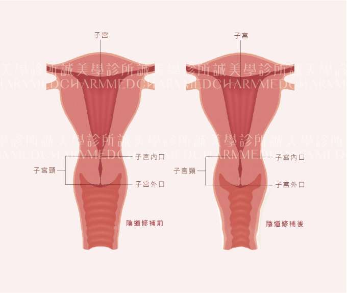 陰道緊實手術