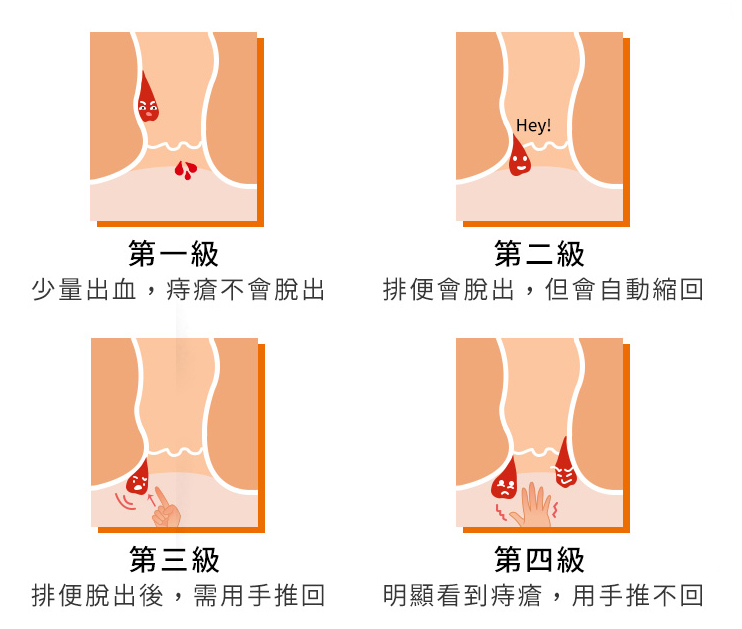 Vaser威塑超音波抽脂手術原理