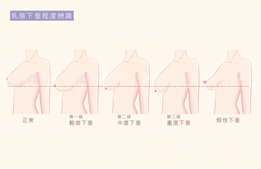 提乳、縮乳、女性平胸