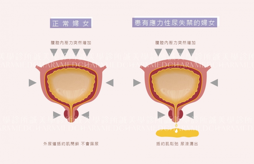 VIVEVE 薇薇電波系統