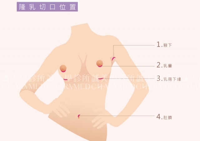 隆乳切口位置手術方式