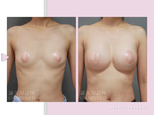 “賽彬 ”矽膠充 填之乳房植入物｜台中隆乳