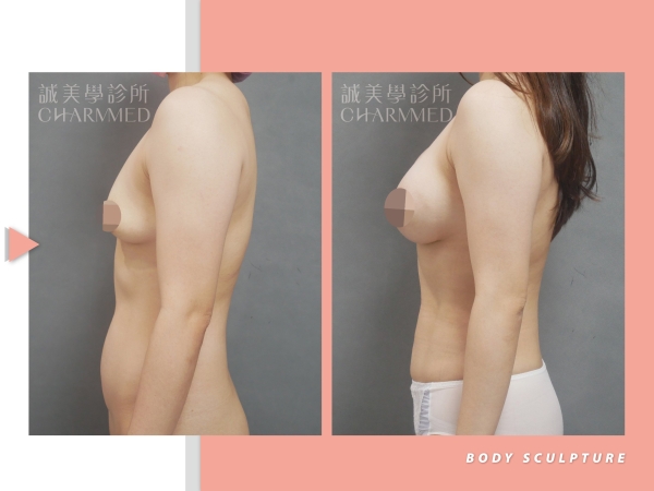 腹部抽脂 / "梭達" 威塑超音波手術吸引系統