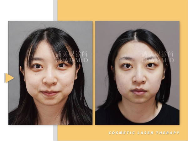 洛明尼斯雷射系統(M22彩衝光)