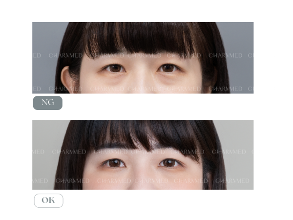 眼袋内開+自體脂肪補蘋果肌