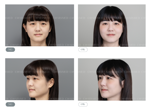 眼袋内開+自體脂肪補蘋果肌 （全臉呈現）