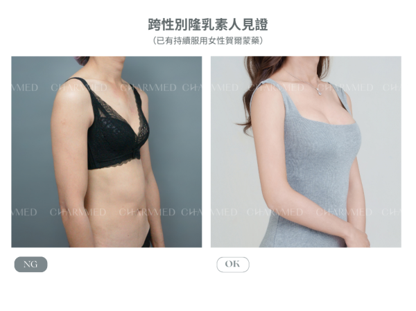 跨性別隆乳（珍珠波）