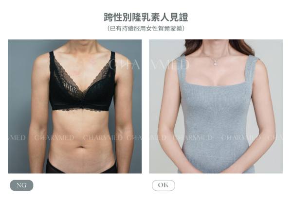 跨性別隆乳（珍珠波）